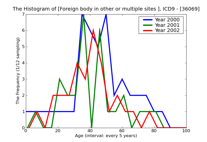 ICD9 Histogram Foreign body in other or multiple sites nonmagnetic
