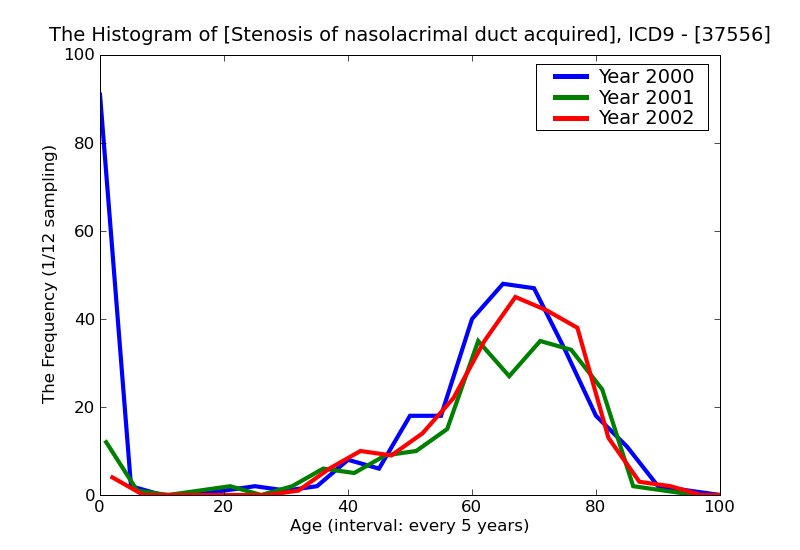 ICD9 Histogram Stenosis of nasolacrimal duct acquired