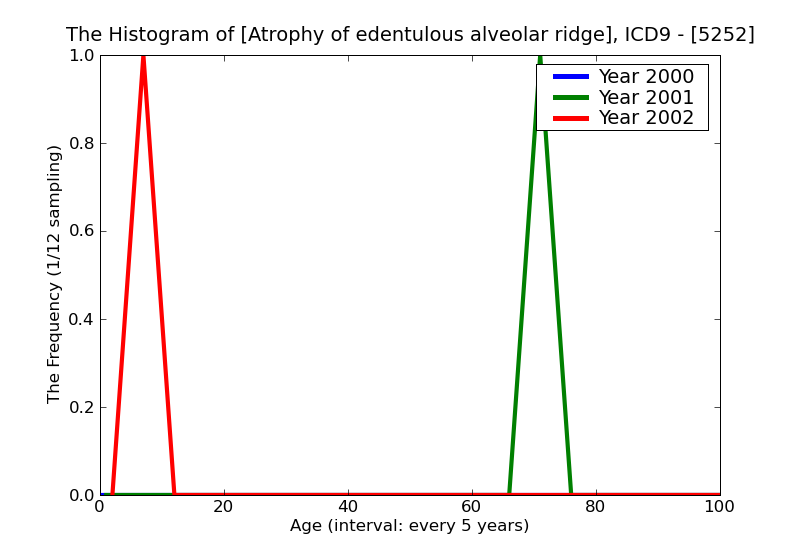 ICD9 Histogram Atrophy of edentulous alveolar ridge