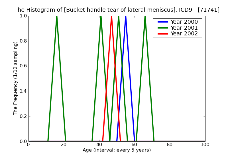 ICD9 Histogram Bucket handle tear of lateral meniscus