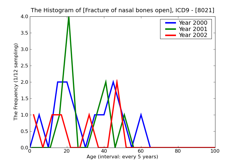 ICD9 Histogram Fracture of nasal bones open