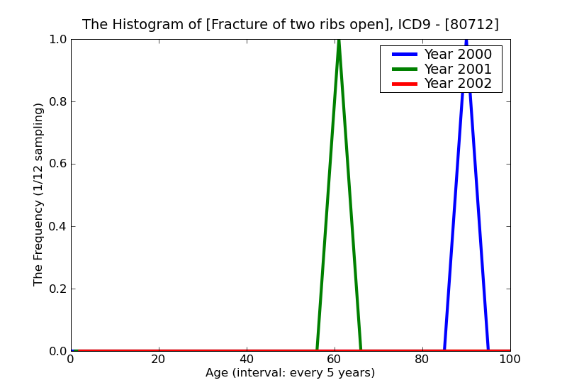ICD9 Histogram Fracture of two ribs open