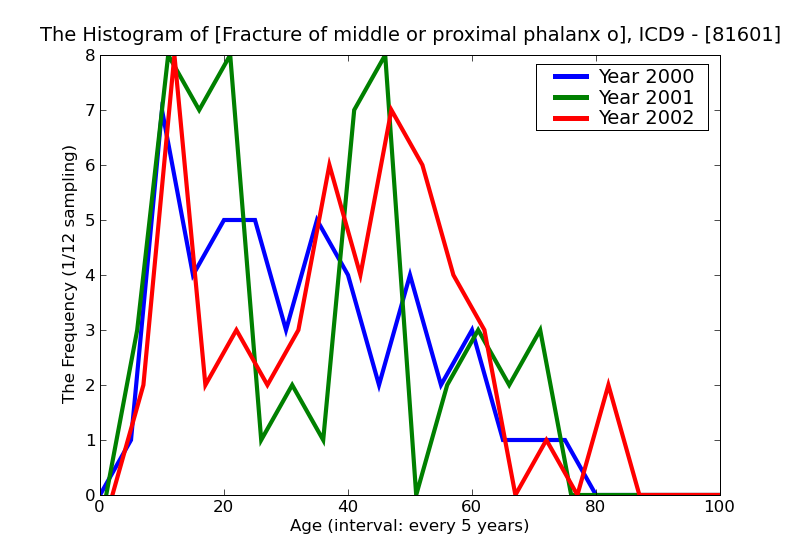 ICD9 Histogram Fracture of middle or proximal phalanx or phalanges closed