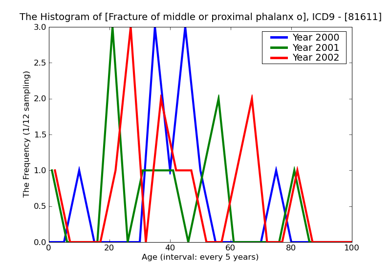 ICD9 Histogram Fracture of middle or proximal phalanx or phalanges open