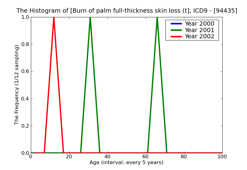 ICD9 Histogram Burn of palm full-thickness skin loss (third degree NOS)